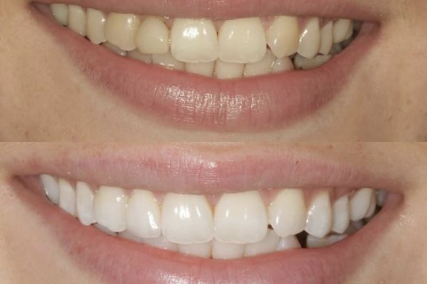 Blanchiment dentaire