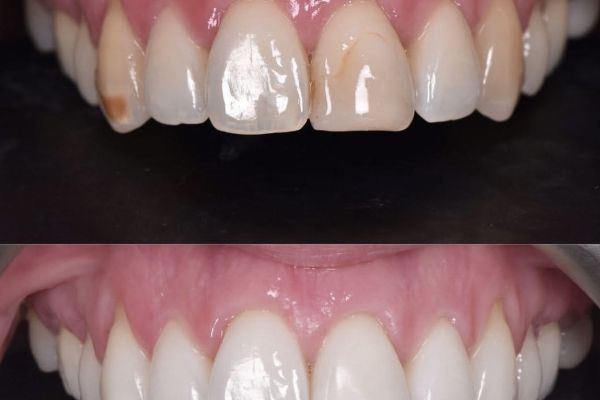 Blanchiment dentaire