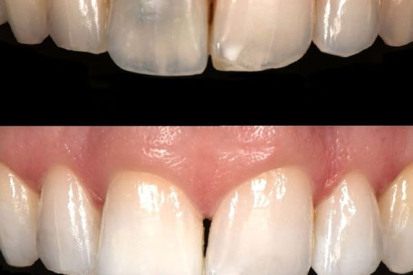 Blanchiment dentaire