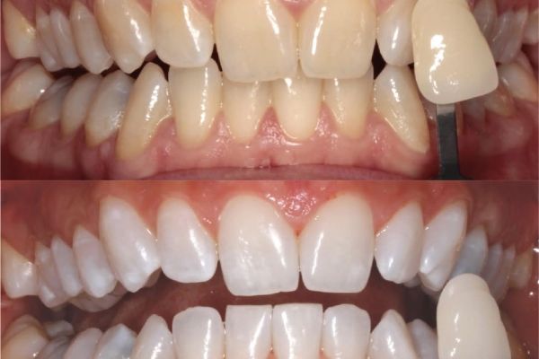 Blanchiment dentaire