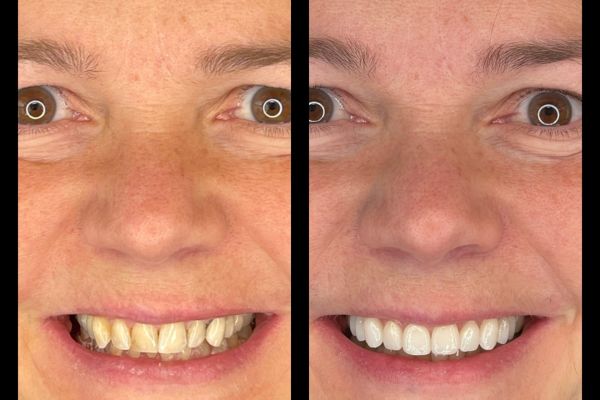 facette ceramique et couronne ceramique