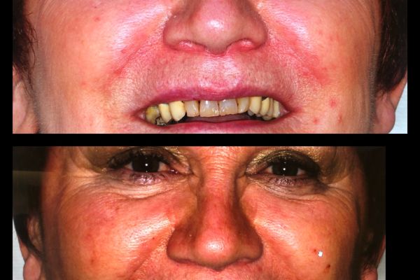 facette ceramique et implant dentaire