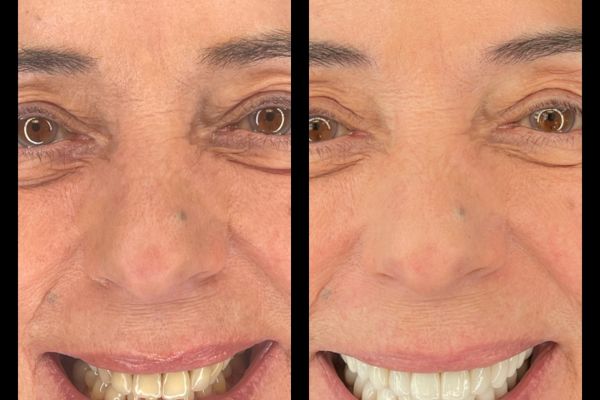 facette ceramique et overlay avec augmentation de dimension verticale