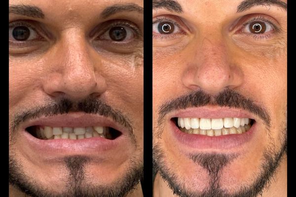 invisalign et facette ceramique