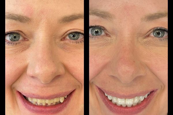 RECONSTRUCTION FULL ARCH SUR IMPLANT