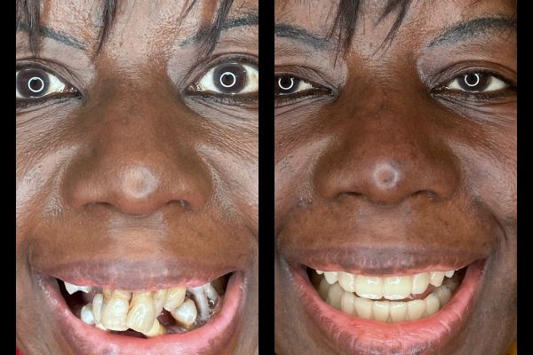 RECONSTRUCTION FULL ARCH SUR IMPLANT