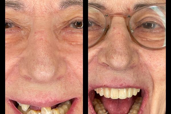 RECONSTRUCTION FULL ARCH SUR IMPLANT