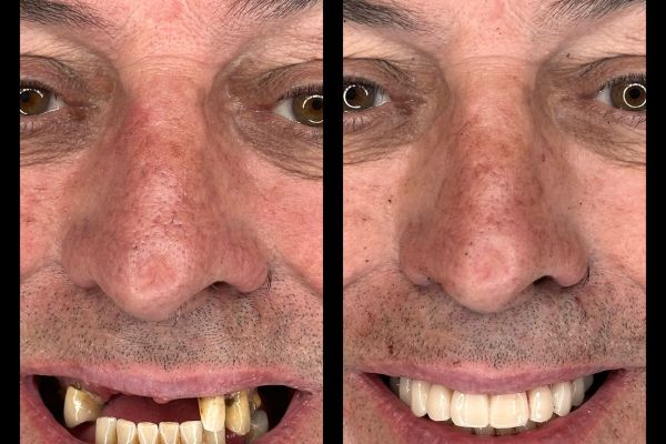 RECONSTRUCTION FULL ARCH SUR IMPLANT