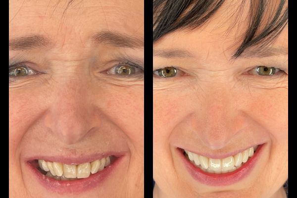 RECONSTRUCTION FULL ARCH SUR IMPLANT