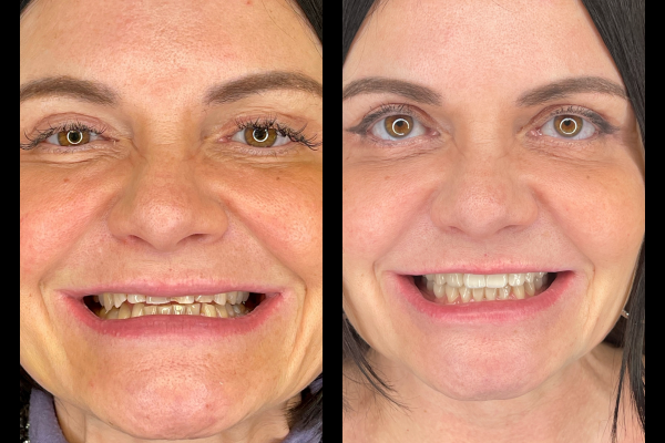 RECONSTRUCTION PROTHETIQUE POUR USURE DENTAIRE